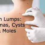 skin lumps surgery: lipoma, cyst and mole removal